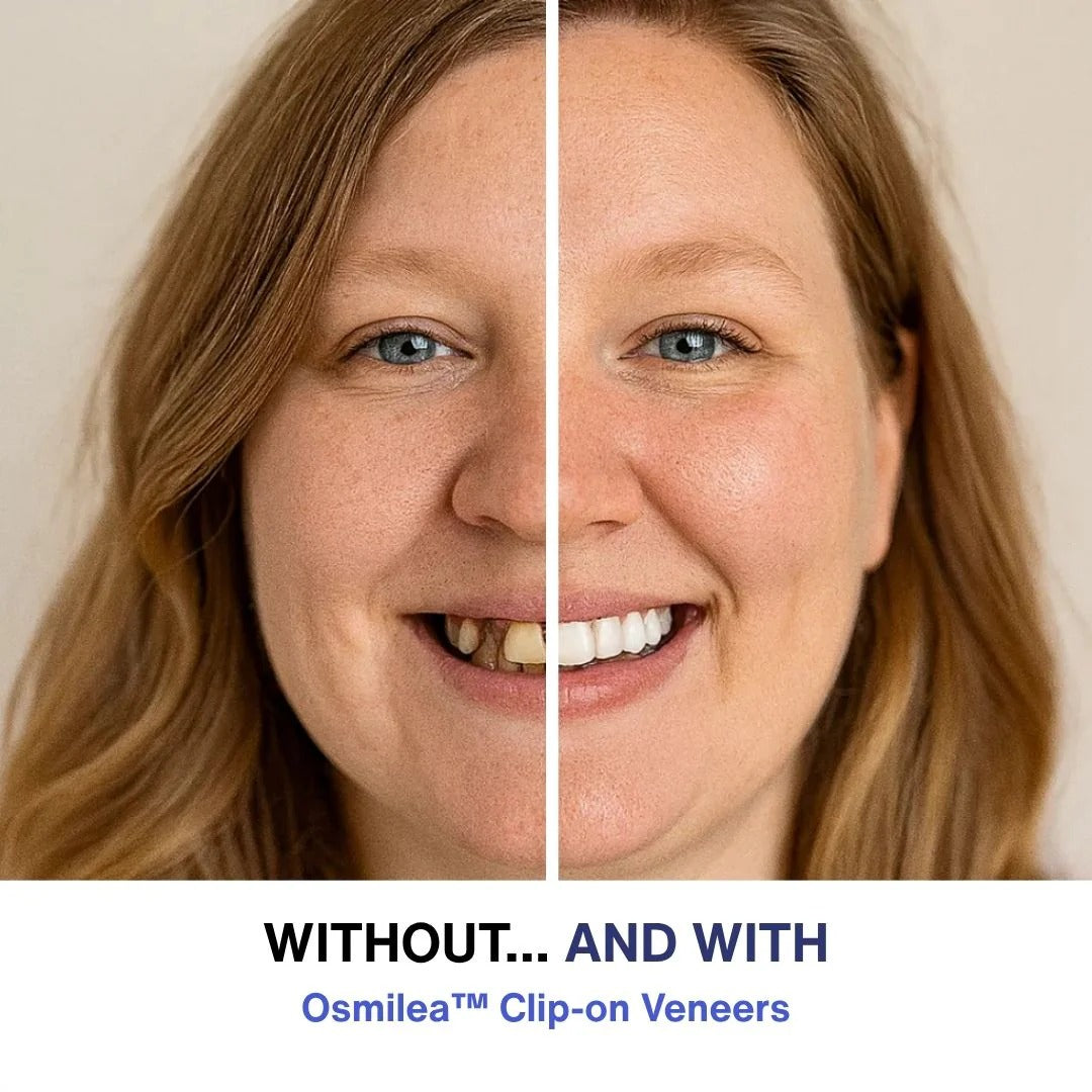 Clip-On Veneers